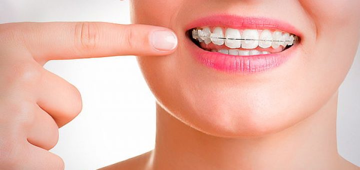 Llaman a tener cuidado con consultorios que ofrecen "Brackets baratos"
